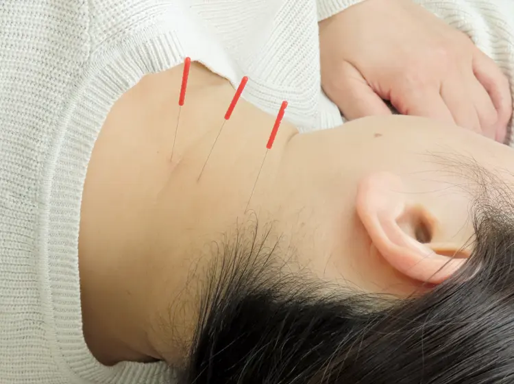 当院で使用する鍼