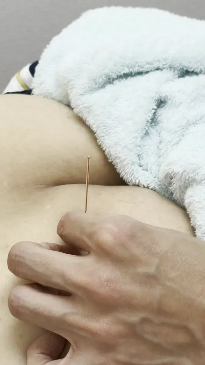 当院で肩に鍼を打つ様子（つまんだ指の上に鍼が垂直に立つ）